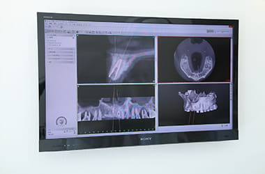 シンプラント3D解析